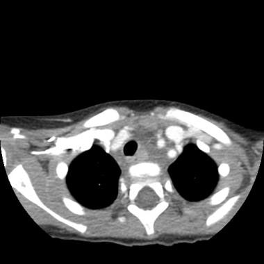 Axial contrasted image of the 3-year-old patient, 