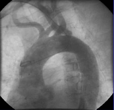Transradial cardiac angiogram showing pigtail cath