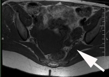 Sciatic Nerve Decompression: Background, Indications, Technical  Considerations