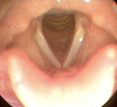 A vocal cord examination via flexible fiberoptic l
