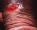 Granuloma Inguinale (Donovanosis)