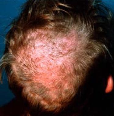 Tinea favosa of the scalp shows erythematous lesio