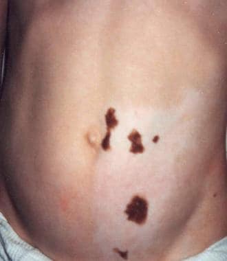 Area of disordered pigmentation on the trunk of a 
