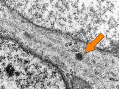 Electron micrograph of Merkel cell carcinoma showi