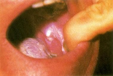 Leukokeratosis of the oral mucosa is a prominent s