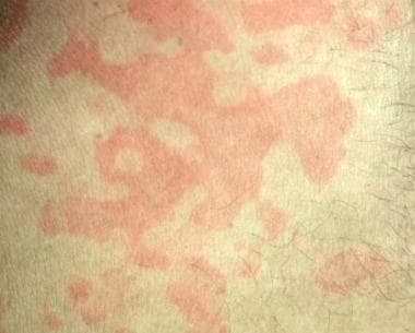 Figurate erythema. Courtesy of M. King and J. Craw