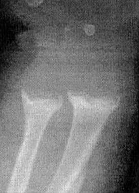 Flared metaphyses of the ulna and radius in a 5-mo