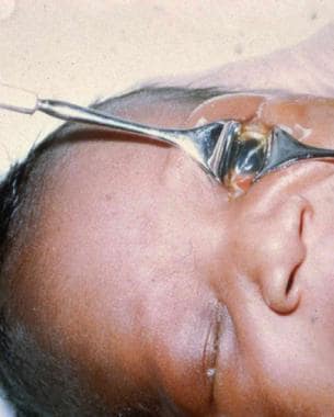 Cloudy cornea without ulcer in neonatal gonococcal
