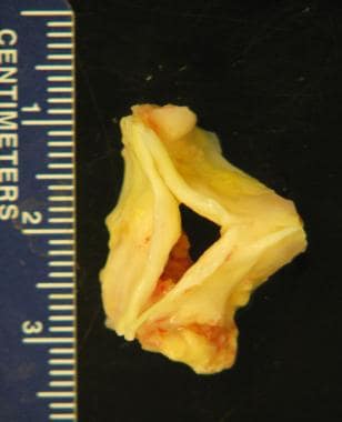 Aortic Stenosis Pathology. Bicuspid aortic stenosi