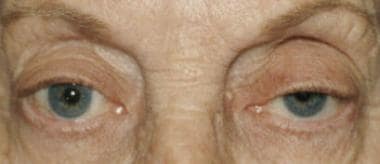 Left ptosis. Lid crease is absent on the left. The