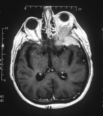 Meningioma of the orbit. Axial sequence on T1-weig