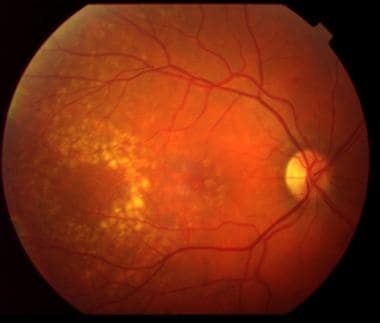 Moderate nonexudative age-related macular degenera