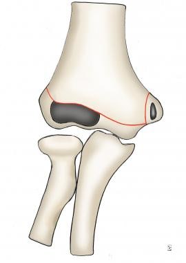 Humerus  Complete Anatomy