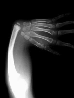 Radial Longitudinal Deficiency (Radial Club Hand)