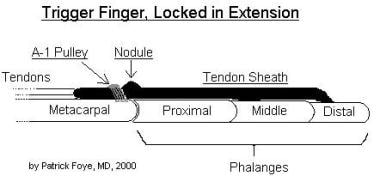 Inflamed nodule can restrict tendon from passing s