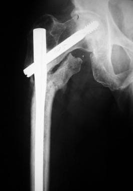 Painful nonunion of a peritrochanteric fracture in
