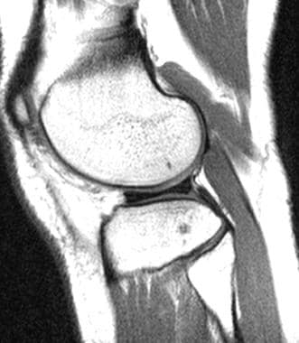 MRI scan of typical discoid meniscus. Image courte