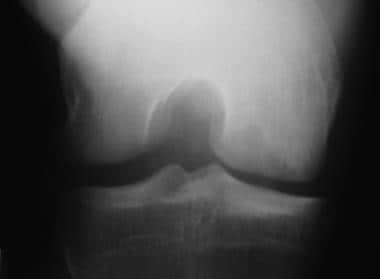 Osteochondritis dissecans. Tunnel-view radiograph 
