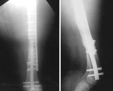 Fracture around stable rod implant treated with pl