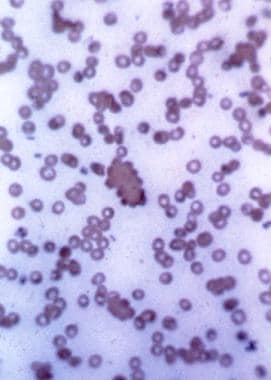 Peripheral blood smear showing several clumps of R