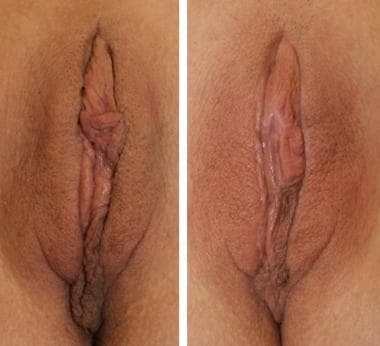 Labiaplasty results. Before (left) and 1 year afte