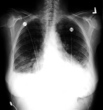 This patient developed acute respiratory failure t