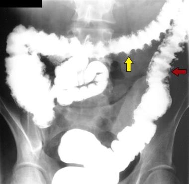 Ulcerative Colitis. Single-contrast enema study in