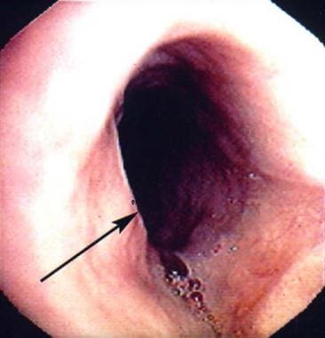 An upper esophageal web (arrow) in a patient with 