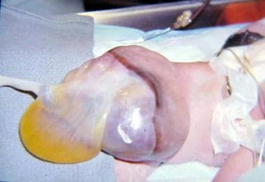 Note translucent sac in baby with large omphalocel