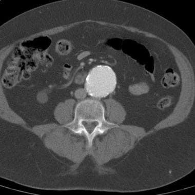 Abdominal Aortic Aneurysm: Practice Essentials, Background, Anatomy