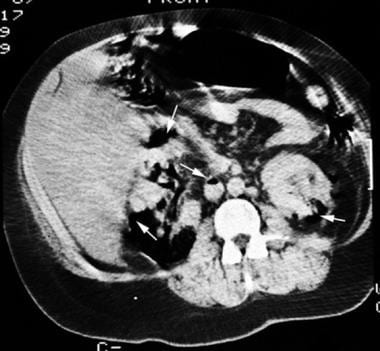 CT scan showing gas in both kidneys and the inferi