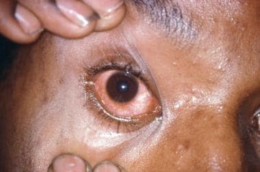 gonorrhea eye treatment