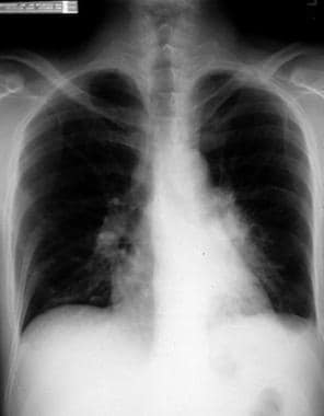Chest radiograph in a patient with Mycobacterium k