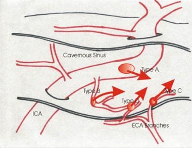 Carotid Cavernous Fistula Practice Essentials Prognosis