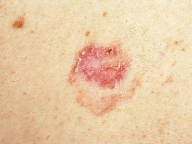 superficial basal cell carcinoma