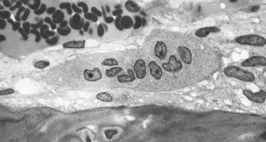 Osteoclast, with bone below it. This image shows t