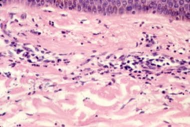 Histopathology of leukocytoclastic vasculitis. 