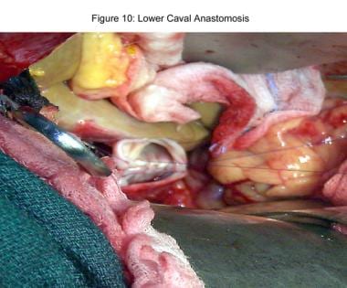 Liver transplantation. Lower caval anastomosis. 