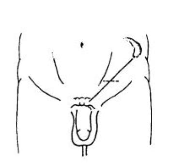 Incision for an inguinal approach to varicocele re