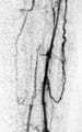 Thromboangiitis Obliterans (Buerger Disease)