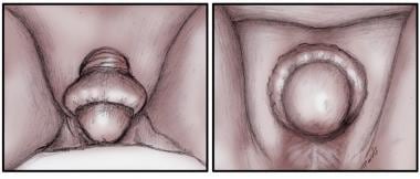 Phimosis and Paraphimosis In the ED Clinical Presentation: History