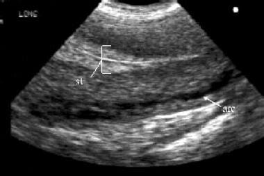 Endovaginal longitudinal view of the uterus: The e