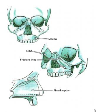 Facial Fractures Clinical Presentation: History, Physical, Physical ...