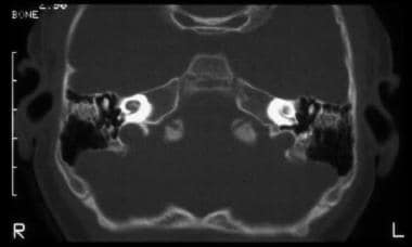 Labyrinthitis ossificans is shown on axial CT scan