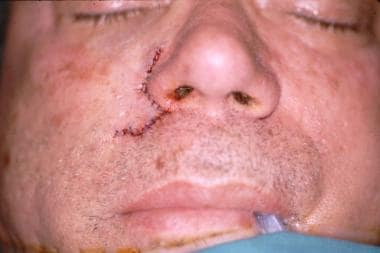 Postoperative frontal view of Mohs defect. 