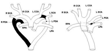 Right Aortic Arch in Vascular Ring Defects: Background, Pathophysiology ...