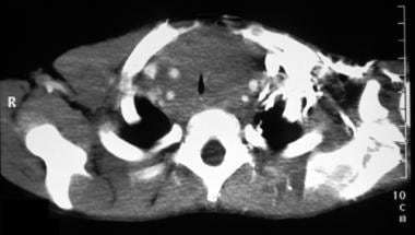 A CT scan showing an anterior mediastinal mass and