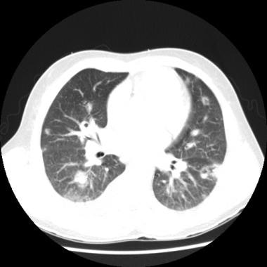 CT scan of the thorax (lung windows) of a 15-year-