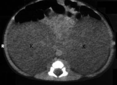 CT显示双侧肿大的肾脏光滑。帖前