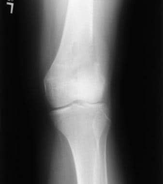 Anteroposterior plain radiograph of the same with 